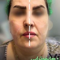 هایفوتراپی (جوانسازی صورت و گردن)|خدمات آرایشگری و زیبایی|تهران, تهران‌سر|دیوار