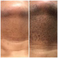 لیزر موهای زائد با دستگاه الکساندرایت کندلا اصل|خدمات آرایشگری و زیبایی|تهران, شهرک غرب|دیوار