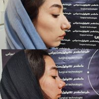 ژل بوتاکس تیپ پلاستی ساکشن در مطب دکتر مقدم|خدمات آرایشگری و زیبایی|تبریز, |دیوار