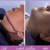 جشنواره ی تخفیف بلفاروپلاستی پلک و ساکشن غبغب|خدمات آرایشگری و زیبایی|تهران, سعادت‌آباد|دیوار