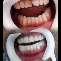 کامپوزیت زیبایی دندان( مدل) فقط توسط دندانپزشک|خدمات آرایشگری و زیبایی|تهران, صادقیه|دیوار