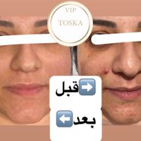 کرم ضدلک و ضدجوش قوی (vip توسکا)|خدمات آرایشگری و زیبایی|تهران, استاد معین|دیوار