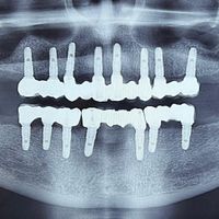 کلینیک تخصصی ایمپلنت دیجیتال/دندانپزشکی کاشت دندان|خدمات آرایشگری و زیبایی|تهران, پاسداران|دیوار