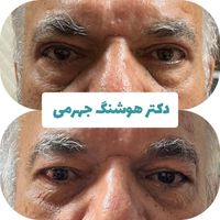 جراحی پلک بلفاروپلاستی توسط متخصص چشم|خدمات آرایشگری و زیبایی|تهران, شهرک غرب|دیوار