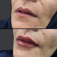 لیزر co2/لیزر موی زائد/لیپوماتیک/هایفو/فیلر|خدمات آرایشگری و زیبایی|تهران, سعادت‌آباد|دیوار