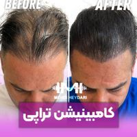 تزریق ژل لب بوتاکس لیفت شقیقه زاویه سازی|خدمات آرایشگری و زیبایی|تهران, سعادت‌آباد|دیوار