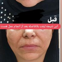 مدل لاغری بدون دستگاه و بدون عوارض‌|استخدام درمانی، زیبایی، بهداشتی|شیراز, قدوسی غربی|دیوار