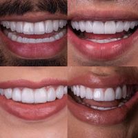 جشنواره کامپوزیت لمینیت روکش عصب ونیر ترمیم بریدج|خدمات آرایشگری و زیبایی|تهران, هفت حوض|دیوار