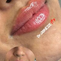 آفر ویژه با تزریق یک سی سی فیلر یه بوتاکس رایگان|خدمات آرایشگری و زیبایی|تهران, هفت حوض|دیوار