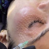 تزریق ژل بوتاکس فیلر مزوتراپی|خدمات آرایشگری و زیبایی|کرج, گوهردشت|دیوار