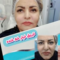 بوتاکس/ژلگونه چانه فک/مادلینگ/لیفت نخ ابرو/فول فیس|خدمات آرایشگری و زیبایی|تهران, فدک|دیوار