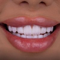کامپوزیت  لمینت   لیرینگ|خدمات آرایشگری و زیبایی|تهران, هروی|دیوار