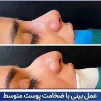 جشنواره عمل جراحی بینی رینوپلاستی بینی گوشتی|خدمات آرایشگری و زیبایی|تهران, میدان ولیعصر|دیوار