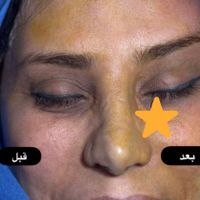 لیفت شقیقه بلفاروپلاستی|خدمات آرایشگری و زیبایی|تهران, میرداماد|دیوار