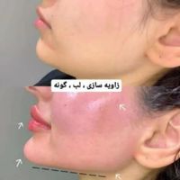 آموزش ژل و بوتاکس. لیفت صورت بانخ (کلینیک)|خدمات آرایشگری و زیبایی|بندرعباس, |دیوار