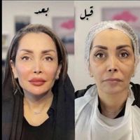 لحظات آخر جشنواره لیفت/جوانسازی با هایفو فقط ۸۹۰ت|خدمات آرایشگری و زیبایی|اصفهان, باغ زیار|دیوار