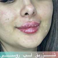 دکترمهسا لیپ،فیلرلب روسی زاویه فک ژل چانه کات گونه|خدمات آرایشگری و زیبایی|تهران, پونک|دیوار