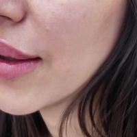 لیزر وخدمات درمانی پوست مو با بهترین کیفیت در جردن|خدمات آرایشگری و زیبایی|تهران, جردن|دیوار