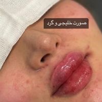 ژل لب گونه چونه زاویه سازی بوتاکس خط خنده|خدمات آرایشگری و زیبایی|قم, زنبیل‌آباد (شهید صدوقی)|دیوار