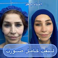 لیفت کامل صورت ۲۵ملیون|خدمات آرایشگری و زیبایی|تهران, قیطریه|دیوار