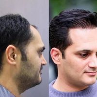 کاشت مو و‌یک جلسه مزوتراپی یک جلسه پی آر پی رایگان|خدمات آرایشگری و زیبایی|تهران, جردن|دیوار