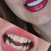 کامپوزیت دندان /لمینیت/وتمامی خدمات دندان پزشکی|خدمات آرایشگری و زیبایی|تهران, فرمانیه|دیوار