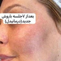 رفع انواع تیرگی و مشکلات پوستی|پزشکی|تهران, تهرانپارس شرقی|دیوار