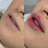 جشنواره تزریق ژل فیلر و بوتاکس و پی آر پی ( PRP )|خدمات آرایشگری و زیبایی|تهران, جنت‌آباد جنوبی|دیوار