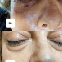 رفع چروک زیر چشم/رفع پف زیر چشم|خدمات آرایشگری و زیبایی|اصفهان, خلجا|دیوار