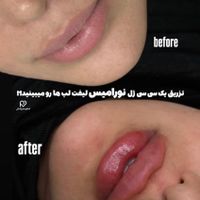 ژل بوتاکس فیلر مطب دکتر لاغری کلینیک پزشک|خدمات آرایشگری و زیبایی|قم, زنبیل‌آباد (شهید صدوقی)|دیوار