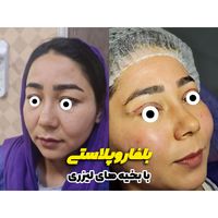 تزریق چربی هالییودی، لیپو غبغب،بوکال فت|خدمات آرایشگری و زیبایی|تهران, ونک|دیوار