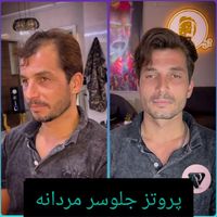 پروتزمو/ترمیم پروتزمو/روشی نوین جایگزین کاشت مو|خدمات آرایشگری و زیبایی|اصفهان, آفاران|دیوار