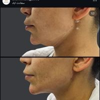 لیزر co2/لیزر موی زائد/لیپوماتیک/هایفو/فیلر|خدمات آرایشگری و زیبایی|تهران, سعادت‌آباد|دیوار