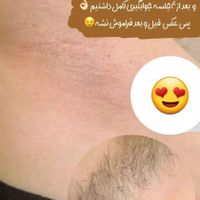 لیزر موهای زائد بدون درد جوابدهی صددرصد|خدمات آرایشگری و زیبایی|تهران, تهرانپارس غربی|دیوار