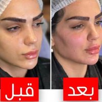 جشنواره  تزریق چربی لیزر لاغری ژل بوتاکس|خدمات آرایشگری و زیبایی|تهران, هفت حوض|دیوار