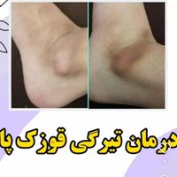 رفع تیرگی بدن ریموتتو لیزرموهای زائد ژل بوتاکس|خدمات آرایشگری و زیبایی|قم, باجک (۱۹ دی)|دیوار