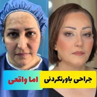 لیفت کامل صورت ۲۵ملیون|خدمات آرایشگری و زیبایی|تهران, قیطریه|دیوار