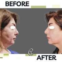 جراحی رفع غبغب لیپوساکشن اندولیفت و بوکال فت|خدمات آرایشگری و زیبایی|تهران, شهرک غرب|دیوار