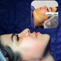 ساکشن غبغب بوکال فت بلفارو پیکر تراشی کاشت ابرو|خدمات آرایشگری و زیبایی|تهران, پونک|دیوار