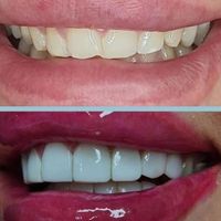 کامپوزیت دندان /لمینیت/وتمامی خدمات دندان پزشکی|خدمات آرایشگری و زیبایی|تهران, فرمانیه|دیوار