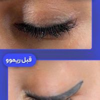 پاک کردن تتوی صورت شما تخصص ماست|خدمات آرایشگری و زیبایی|تهران, منیریه|دیوار