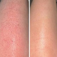 لیزر موهای زائد با دستگاه الکساندرایت کندلا اصل|خدمات آرایشگری و زیبایی|تهران, شهرک غرب|دیوار