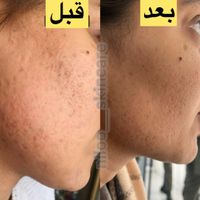فیشال و پاکسازی،مزونیدلینگ،مزوتراپی،کربوکسی،آنزیم|خدمات آرایشگری و زیبایی|اصفهان, ملک‌شهر|دیوار