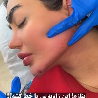 تزریق ژل حرفه ای بدون درد و عوارض|خدمات آرایشگری و زیبایی|تهران, هفت حوض|دیوار