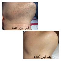لیزر موهای زائد با دستگاه الکساندرایت کندلا اصل|خدمات آرایشگری و زیبایی|تهران, شهرک غرب|دیوار