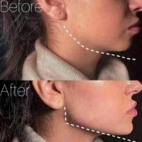 آموزش ژل و بوتاکس. لیفت صورت بانخ (کلینیک)|خدمات آرایشگری و زیبایی|بندرعباس, |دیوار