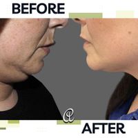 جراحی رفع غبغب لیپوساکشن اندولیفت و بوکال فت|خدمات آرایشگری و زیبایی|تهران, شهرک غرب|دیوار