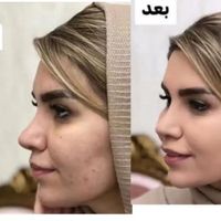 پنکک معروف به فیلتر اینستا|آرایشی، بهداشتی، درمانی|تهران, پونک|دیوار