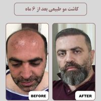 بلفارو پلاستی، کاشت مو، ابرو و هایفوتراپی هفت بعدی|خدمات آرایشگری و زیبایی|تهران, ستارخان|دیوار