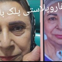 «عمل افتادگی پلک(بلفارو پلاستی)»|خدمات آرایشگری و زیبایی|تهران, یوسف‌آباد|دیوار